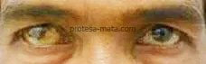 kasus mata strabismus