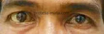 kasus mata strabismus