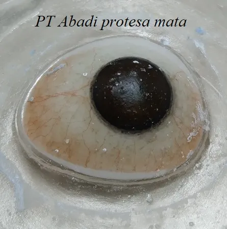 Modifikasi protesa mata lama