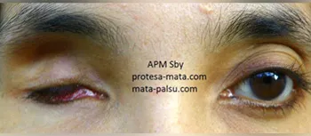 foto pasien abadi protesa mata