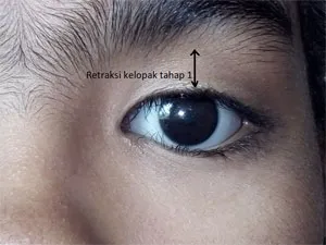 Retraksi kelopak tahap 1 Retraksi kelopak tahap 1